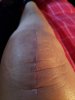 [Bonesmart.org] Knee Scars - Post Your Badges of Honor Here! NO CHIT-CHAT please