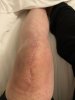 [Bonesmart.org] Knee Scars - Post Your Badges of Honor Here! NO CHIT-CHAT please