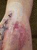 [Bonesmart.org] 2nd knee, 2nd recovery