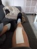 [Bonesmart.org] 2nd knee, 2nd recovery