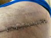 [Bonesmart.org] Hippies scars - post your badges of honor here: NO CHIT-CHAT HERE PLEASE
