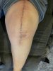 [Bonesmart.org] Knee Scars - Post Your Badges of Honor Here! NO CHIT-CHAT please