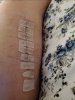 [Bonesmart.org] Lovetocookandsew’s long road to recovery