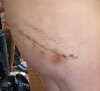 [Bonesmart.org] Hippies scars - post your badges of honor here: NO CHIT-CHAT HERE PLEASE