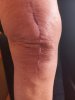 [Bonesmart.org] 2nd knee, 2nd recovery