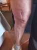 [Bonesmart.org] 2nd knee, 2nd recovery
