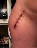[Bonesmart.org] Equestrian's recovery with Ehlers Danlos