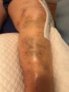 [Bonesmart.org] Knee Scars - Post Your Badges of Honor Here! NO CHIT-CHAT please