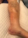 [Bonesmart.org] Knee Scars - Post Your Badges of Honor Here! NO CHIT-CHAT please