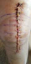 [Bonesmart.org] Knee Scars - Post Your Badges of Honor Here! NO CHIT-CHAT please