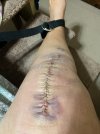 [Bonesmart.org] Knee Scars - Post Your Badges of Honor Here! NO CHIT-CHAT please