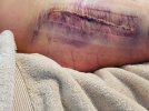 [Bonesmart.org] Hippies scars - post your badges of honor here: NO CHIT-CHAT HERE PLEASE