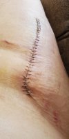 [Bonesmart.org] Hippies scars - post your badges of honor here: NO CHIT-CHAT HERE PLEASE