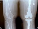 [Bonesmart.org] Mamie's Recovery Thread