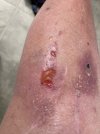 [Bonesmart.org] Mamie's Recovery Thread