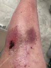 [Bonesmart.org] Mamie's Recovery Thread