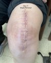 [Bonesmart.org] My Journey