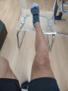 [Bonesmart.org] Post knee surgery realism