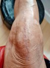 [Bonesmart.org] Knee Scars - Post Your Badges of Honor Here! NO CHIT-CHAT please