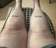 [Bonesmart.org] Knee Scars - Post Your Badges of Honor Here! NO CHIT-CHAT please