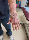 [Bonesmart.org] Four Corner Wrist Fusion