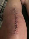 [Bonesmart.org] Knee Scars - Post Your Badges of Honor Here! NO CHIT-CHAT please