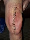 [Bonesmart.org] ski_bum's Recovery Thread