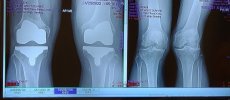 [Bonesmart.org] GlideFloss TKR Report - from Dec 06 '21 on