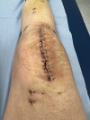 [Bonesmart.org] Knee Scars - Post Your Badges of Honor Here! NO CHIT-CHAT please