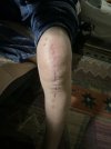 [Bonesmart.org] Knee Scars - Post Your Badges of Honor Here! NO CHIT-CHAT please