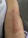 [Bonesmart.org] Knee Scars - Post Your Badges of Honor Here! NO CHIT-CHAT please