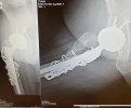 [Bonesmart.org] Seeking Gluteus Maximus Tendon Transfer Advice