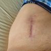 [Bonesmart.org] Hippies scars - post your badges of honor here: NO CHIT-CHAT HERE PLEASE