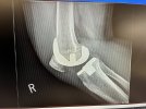 [Bonesmart.org] March 8/22 RTKR Excited for the next step!