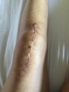 [Bonesmart.org] LTKR journey first few weeks
