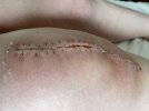 [Bonesmart.org] Hey Jude knee replacement