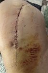 [Bonesmart.org] Hippies scars - post your badges of honor here: NO CHIT-CHAT HERE PLEASE