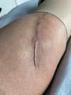 [Bonesmart.org] Hey Jude knee replacement