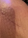 [Bonesmart.org] Hey Jude knee replacement