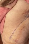 [Bonesmart.org] Hippies scars - post your badges of honor here: NO CHIT-CHAT HERE PLEASE