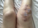 [Bonesmart.org] Hey Jude knee replacement