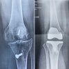 [Bonesmart.org] TKR 2 Years Out