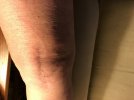 [Bonesmart.org] Second (and hopefully last) TKR Recovery Underway