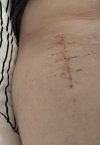 [Bonesmart.org] Hippies scars - post your badges of honor here: NO CHIT-CHAT HERE PLEASE