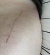 [Bonesmart.org] Hippies scars - post your badges of honor here: NO CHIT-CHAT HERE PLEASE