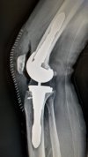 [Bonesmart.org] Revision TKR - Total Revision August 5, 2022