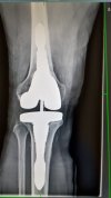 [Bonesmart.org] Revision TKR - Total Revision August 5, 2022