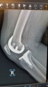 [Bonesmart.org] Revision TKR - Total Revision August 5, 2022