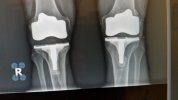 [Bonesmart.org] Revision TKR - Total Revision August 5, 2022