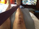 [Bonesmart.org] Revision TKR - Total Revision August 5, 2022